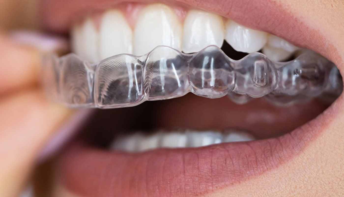 Invisalign à Casablanca