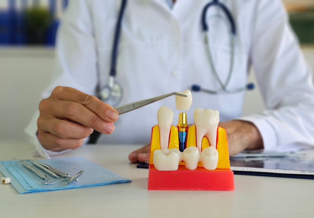 Implants Dentaires Centre Dentaire Oxford