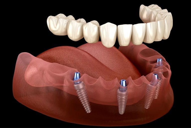 Implants All on X