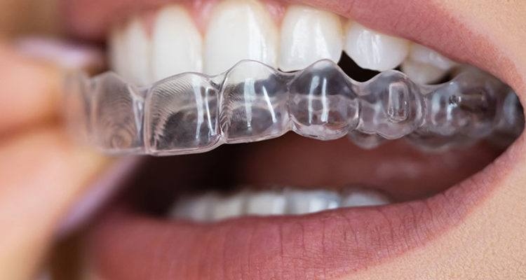 Orthodontie Invisible