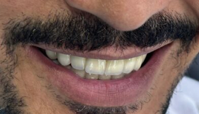 Impression 3D en Dentisterie à Casablanca