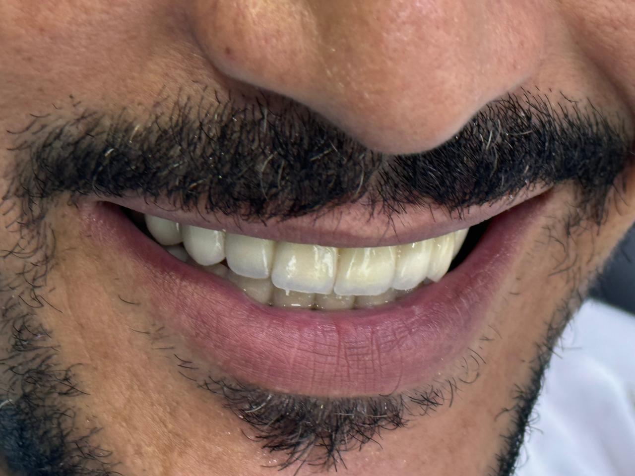 Impression 3D en Dentisterie à Casablanca