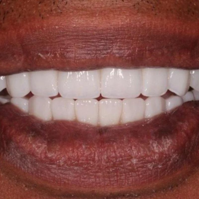 Prothèse Vissée sur Implant