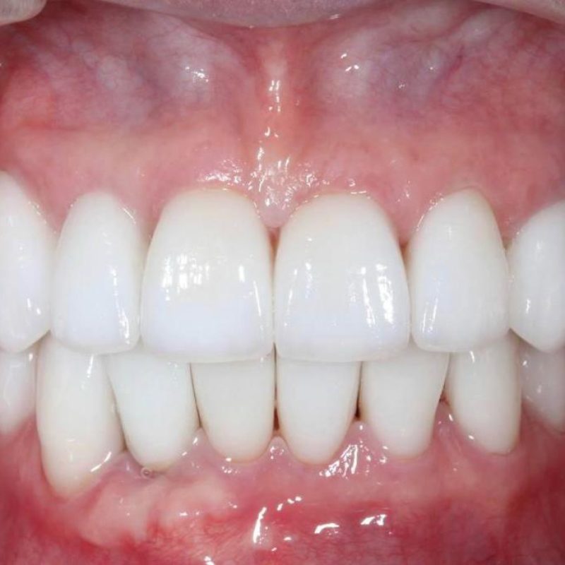 Dépigmentation Gingivale