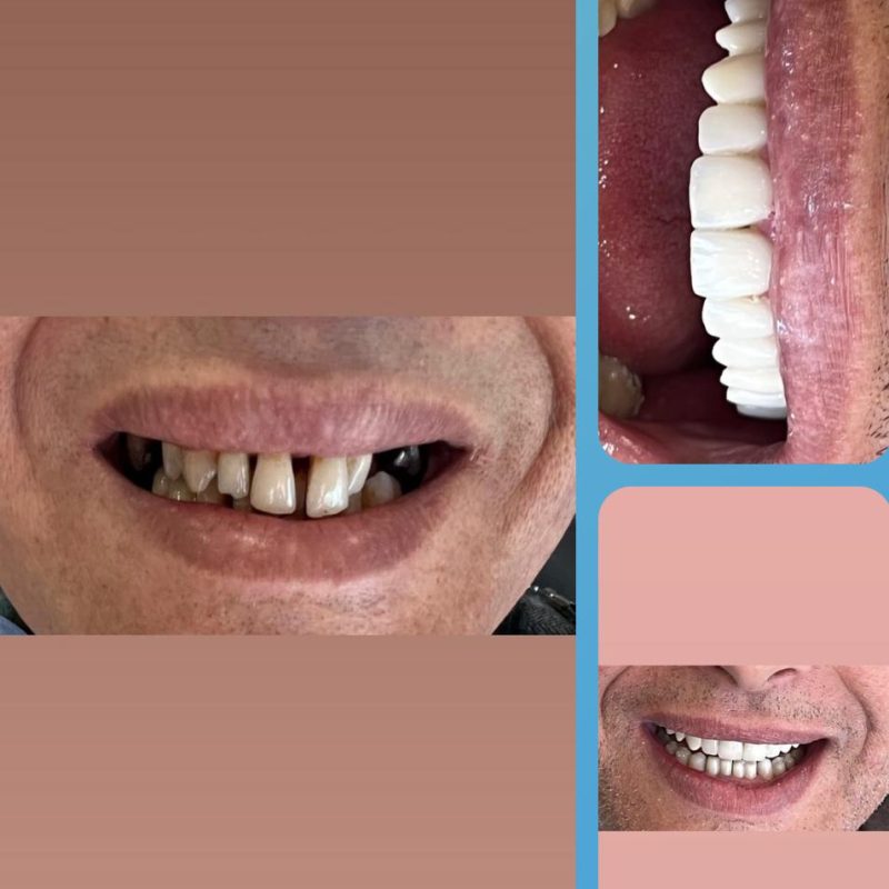 SINUS LIFT