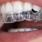 Invisalign à Casablanca