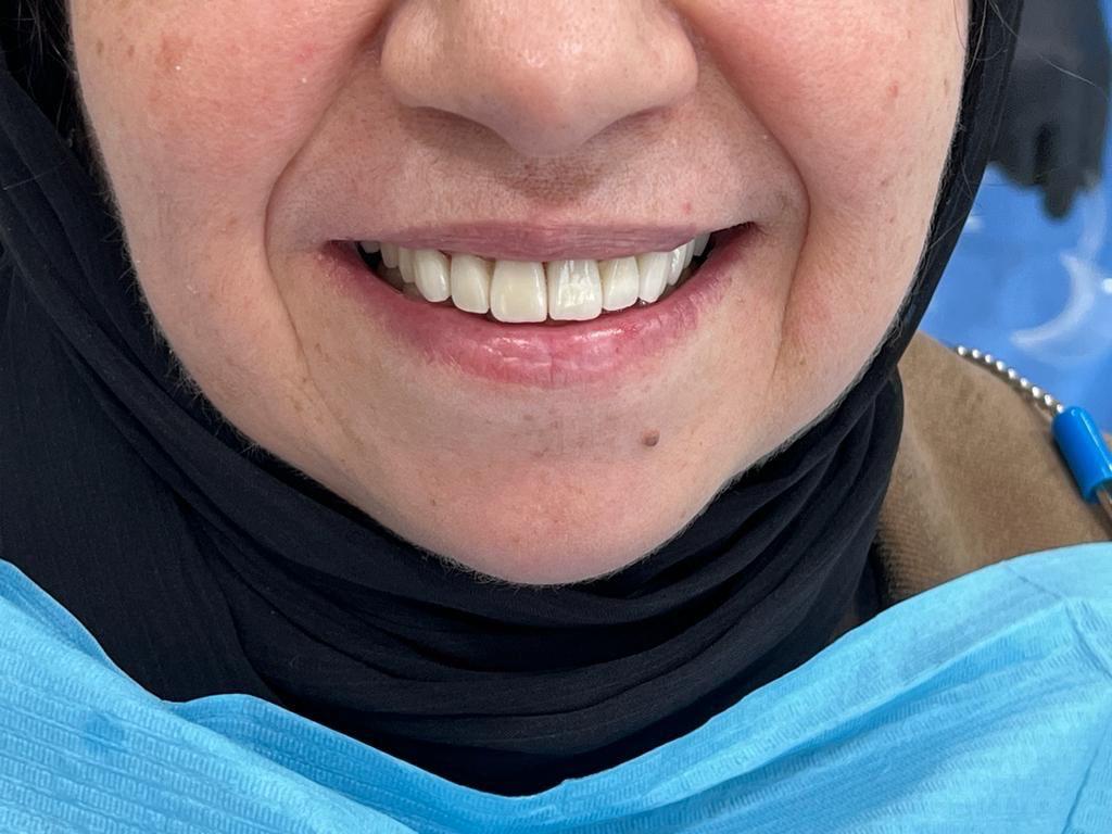 Clinique Dentaire Casablanca gencives saignent