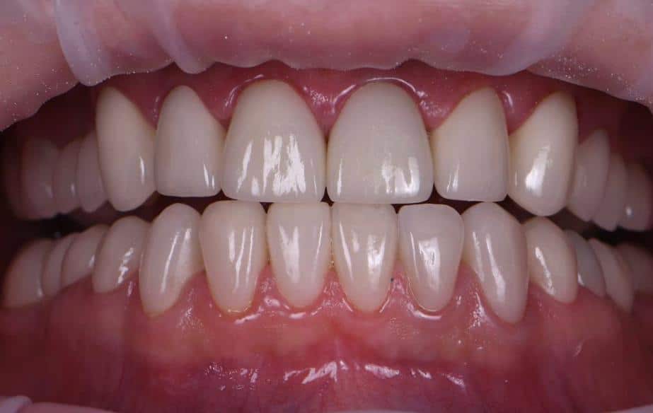 Clinique Dentaire Casablanca parodontologie Casablanca mauvaise haleine
parodontite