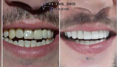 Clinique Dentaire Casablanca blanchiment dentaire