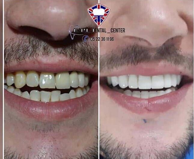 Clinique Dentaire Casablanca blanchiment dentaire