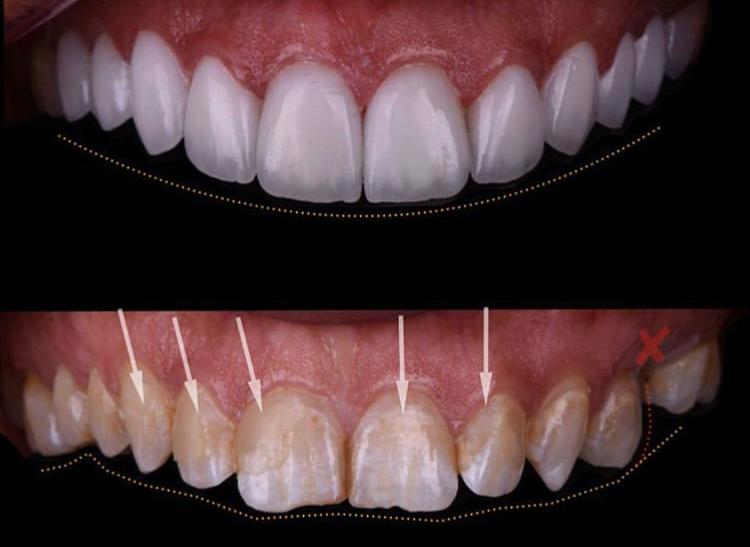 Soins Dentaires Casablanca Premium
parodontite