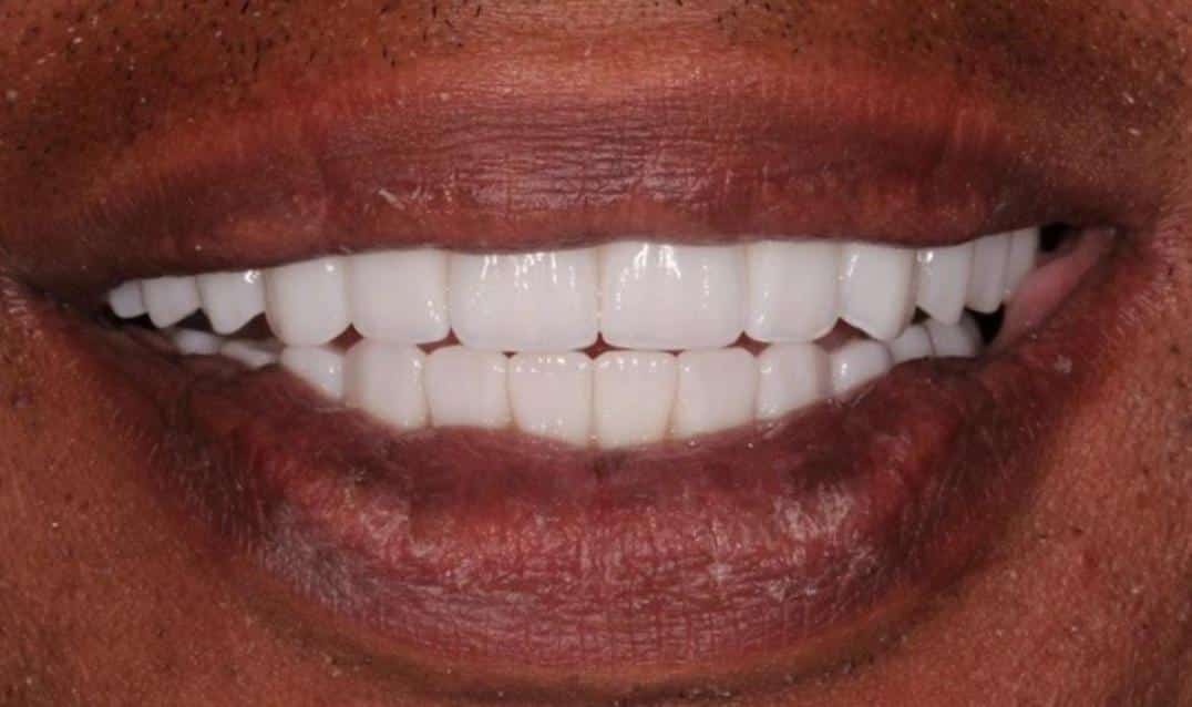 Prothèse Vissée sur Implant