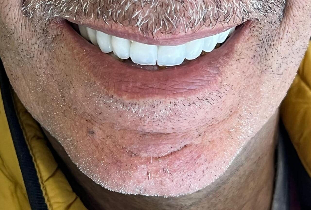 Aéropolisseur Dentaire implant