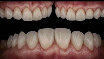 Impression 3D en Dentisterie à Casablanca parodontite