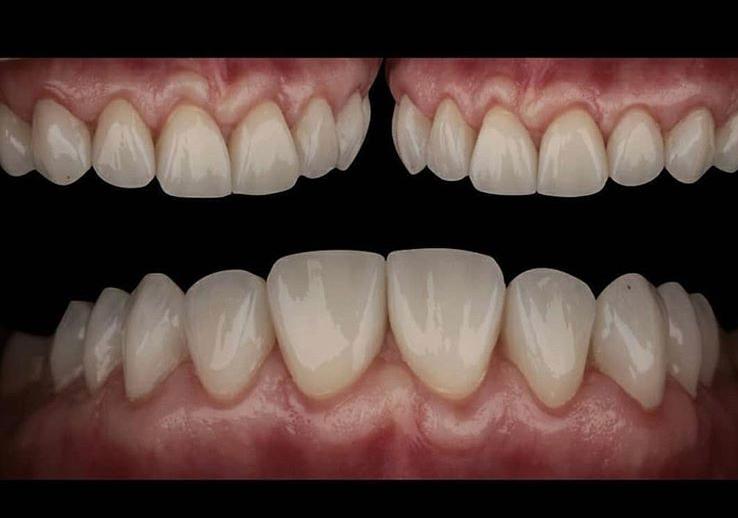 Impression 3D en Dentisterie à Casablanca parodontite