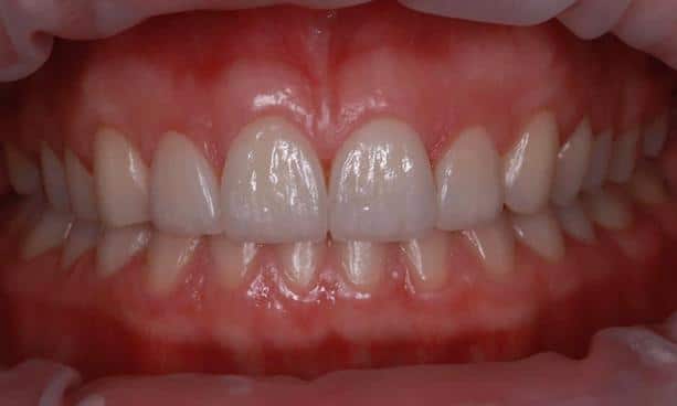 Laser Dentaire casablanca parodontologie Casablanca