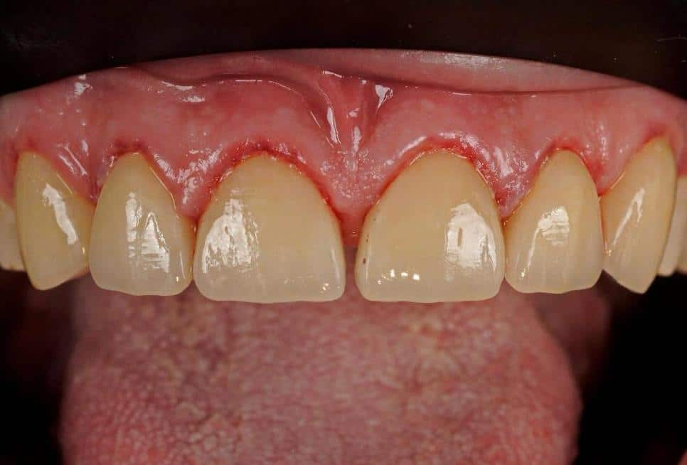 Implantologie guidée Carie dentaire