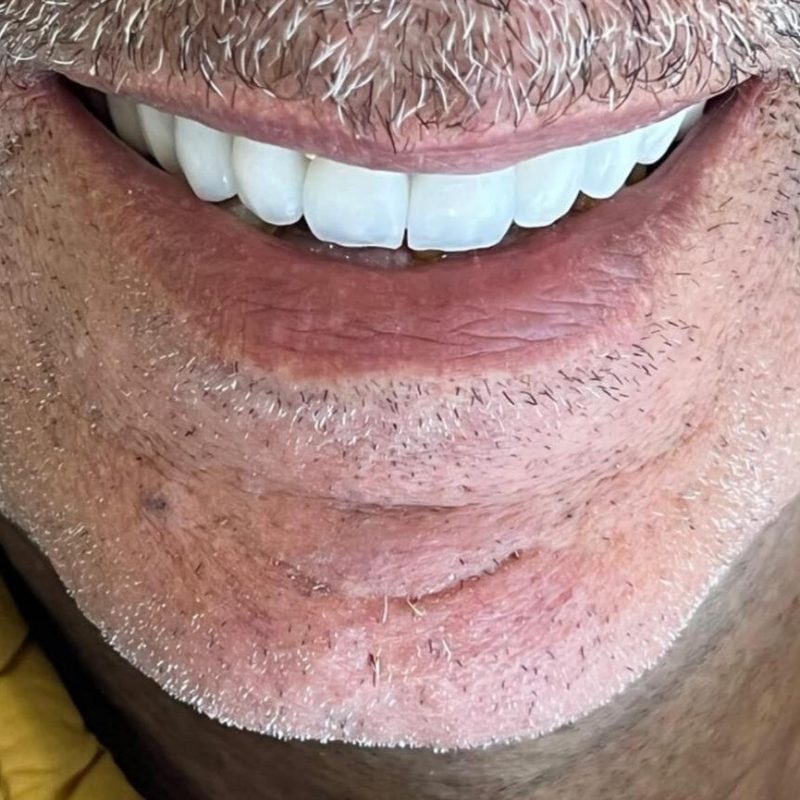 Aéropolisseur Dentaire implant